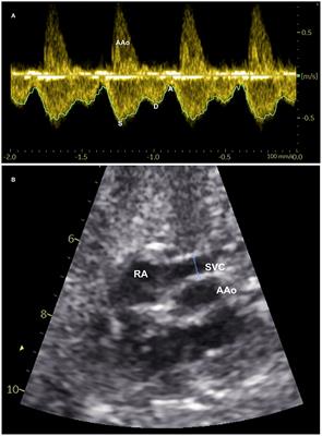 Fetal Superior Vena Cava Blood Flow and Its Fraction of Cardiac Output: A Longitudinal <mark class="highlighted">Ultrasound Study</mark> in the Second Half of Pregnancy